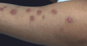 Behcets Disease Rash Autoimmune