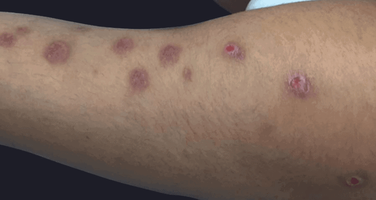 what-causes-an-autoimmune-rash-10-possible-conditions-pictures