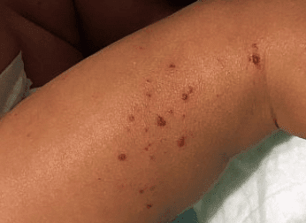 Eczema Rash Autoimmune