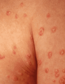 hypothyroidism skin rash