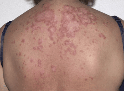 Skin Rashes & Conditions