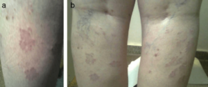 Myxedema Hypothyroidism Rash Autoimmune