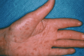 Scleroderma Rash Autoimmune