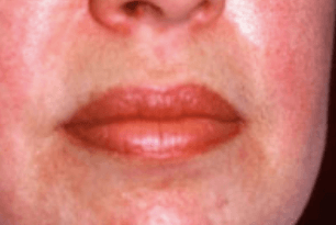 rash under lip