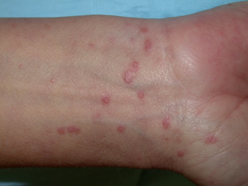 What Do Autoimmune Rashes Look Like? What Causes Them?